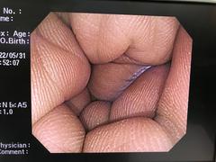 大腸ビデオスコープ｜PCF-Q260AI｜オリンパスメディカルシステムズ株式会社の写真8枚目