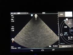 Ultrasound system｜SonoSite iViZ｜Fujifilm Medical photo6