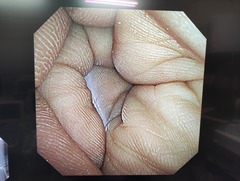 気管支ビデオスコープ｜BF-Q290｜オリンパスメディカルシステムズ株式会社の写真8枚目