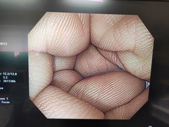 大腸ビデオスコープ｜CF-H290I｜オリンパスメディカルシステムズ株式会社の写真8枚目