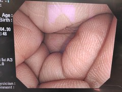 大腸ビデオスコープ｜PCF-Q260AI｜オリンパスメディカルシステムズ株式会社の写真8枚目