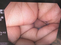 Video Colonoscope｜CF-Q240L｜Olympus Medical Systems photo8