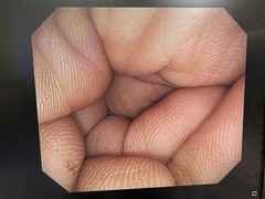 大腸ビデオスコープ｜CF-H260AI｜オリンパスメディカルシステムズ株式会社の写真6枚目