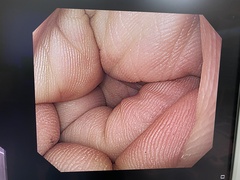 上部消化管汎用ビデオスコープ｜GIF-H260｜オリンパスメディカルシステムズ株式会社の写真6枚目