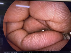 上部消化管用経鼻スコープ｜EG-580NW2｜富士フイルムメディカルの写真8枚目