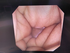 上部消化管汎用ビデオスコープ(径鼻対応)｜GIF-XP260N｜オリンパスメディカルシステムズ株式会社の写真8枚目