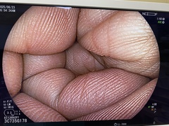 下部消化管用拡大スコープ｜EC-L600ZP7｜富士フイルムメディカルの写真6枚目