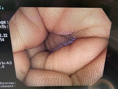 Video Colonoscope｜CF-Q240ZI｜Olympus Medical Systems photo8