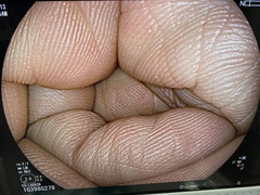 Video Gastroscope｜EG-L600ZW｜Fujifilm photo8