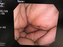 Video Transnasal Gastroscope｜GIF-XP260N｜Olympus Medical Systems photo9