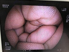 Video Transnasal Gastroscope｜EG-580NW2｜Fujifilm Medical photo9