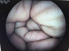 Video Colonoscope｜EC-250WM｜Fujifilm Medical photo9