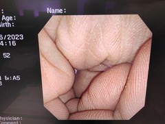 Video Transnasal Gastroscope｜GIF-XP260N｜Olympus Medical Systems photo9