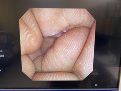 Video Transnasal Gastroscope｜GIF-XP260N｜Olympus Medical Systems photo9