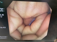 Video Colonoscope｜CF-240I｜Olympus Medical Systems photo9