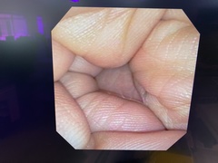 Video Transnasal Gastroscope｜GIF-XP150N｜Olympus Medical Systems photo9