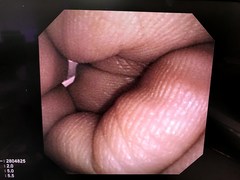 Video Transnasal Gastroscope｜GIF-XP260N｜Olympus Medical Systems photo7