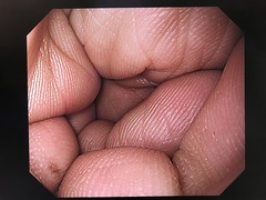 上部消化管汎用ビデオスコープ｜GIF-H260｜オリンパスメディカルシステムズ株式会社の写真10枚目