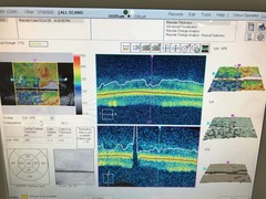 光干渉網膜断層計｜HD-OCT400｜カールツァイスメディテックの写真10枚目
