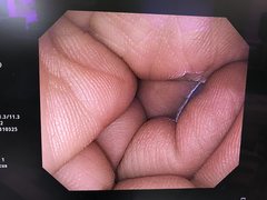 Video Colonoscope｜PCF-Q260AI｜Olympus Medical Systems photo10