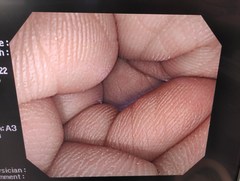 大腸ビデオスコープ｜PCF-Q260AI｜オリンパスメディカルシステムズ株式会社の写真10枚目
