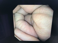 Video Transnasal Gastroscope｜GIF-XP170N｜Olympus Medical Systems photo11