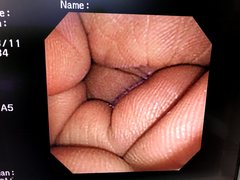 Video Transnasal Gastroscope｜GIF-XP260N｜Olympus Medical Systems photo8