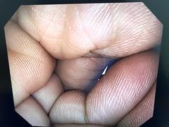 Video Colonoscope｜CF-Q240I｜Olympus Medical Systems photo9