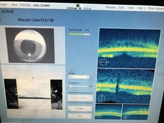 光干渉網膜断層計｜HD-OCT400｜カールツァイスメディテックの写真11枚目