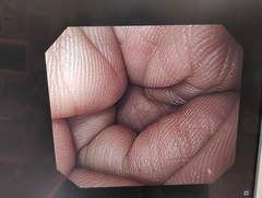 上部消化管汎用ビデオスコープ｜GIF-H260｜オリンパスメディカルシステムズ株式会社の写真11枚目