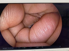 上部消化管用経鼻スコープ｜EG-530NW｜富士フイルムメディカルの写真11枚目