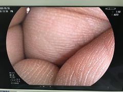 Video Colonoscope｜EC-L590ZW｜Fujifilm Medical photo7
