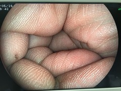 Video Gastroscope｜EG-3000FP｜Fujifilm Medical photo11