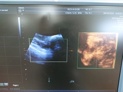 4D超音波診断装置（カラードプラ）｜Voluson E6｜GEヘルスケアの写真13枚目