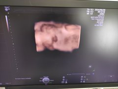 4D超音波診断装置（カラードプラ）｜Voluson E10｜GEヘルスケアの写真14枚目