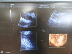 4D超音波診断装置（カラードプラ）｜Voluson E6｜GEヘルスケアの写真14枚目