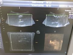 4D超音波診断装置（カラードプラ）｜Voluson P8｜GEヘルスケアの写真17枚目